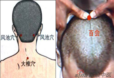 常見(jiàn)病艾灸時(shí)怎樣選穴？--大椎百會(huì)穴